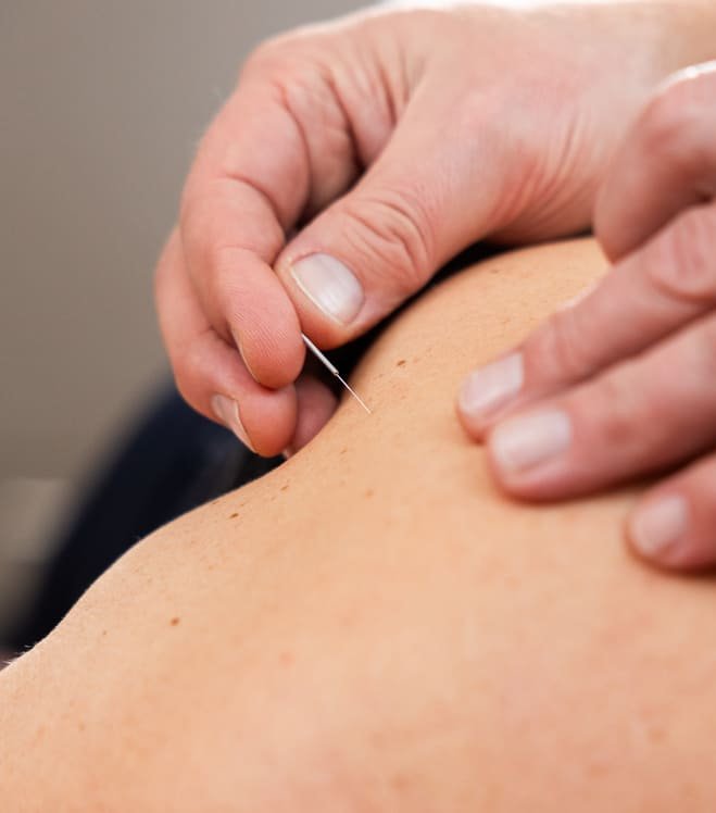 Dry Needling