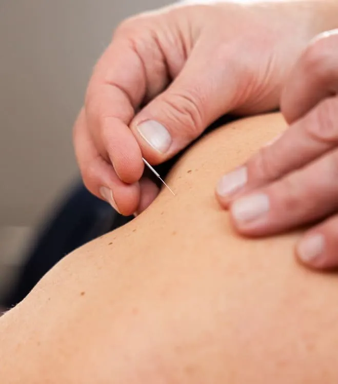 Dry Needling